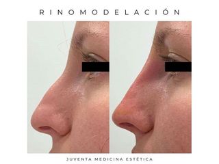 Rinomodelación - Estética Juventa