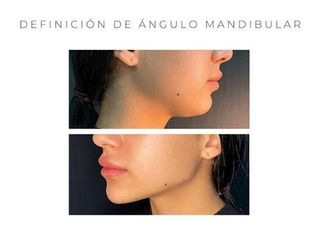 Definición mandibular - Estética Juventa