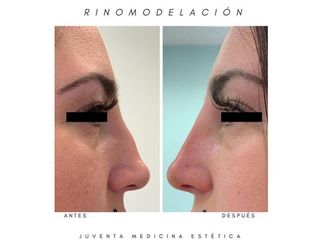 Rinomodelación - Estética Juventa