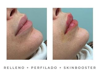 Relleno de labios - Estética Juventa