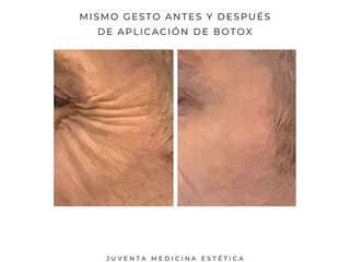 Botox - Estética Juventa