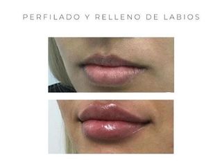 Relleno de labios - Estética Juventa