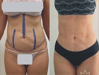 Liposucción antes y después - 817568