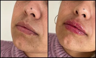 Relleno de labios - Dra. Anahi Versace