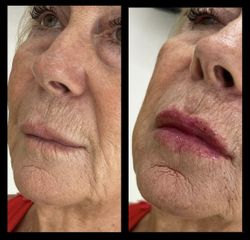 Relleno de labios - Dra. Anahi Versace