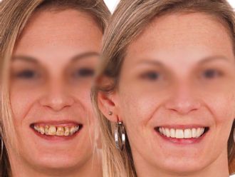 Carillas dentales antes y después - 879117