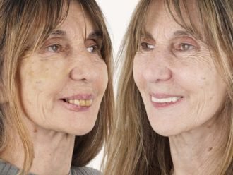 Carillas dentales antes y después - 879118