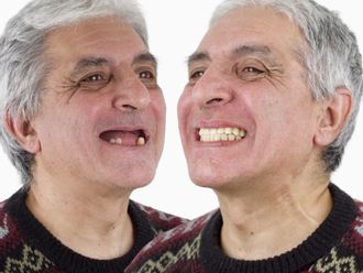 Implantes dentales antes y después - 879119