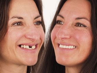 Implantes dentales antes y después - 879120