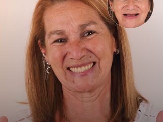 Implantes dentales antes y después - 879123