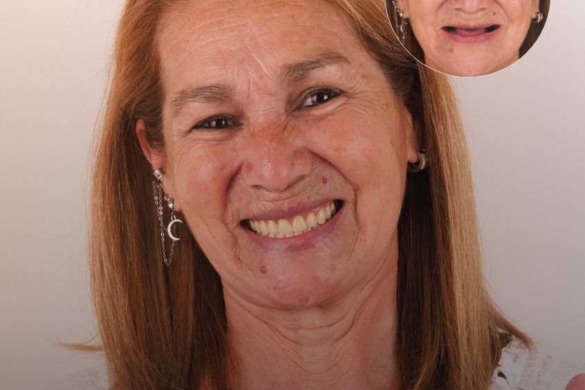 Implantes dentales antes y después - 879123