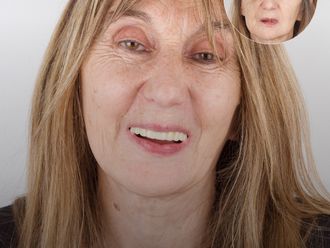 Implantes dentales antes y después - 879124