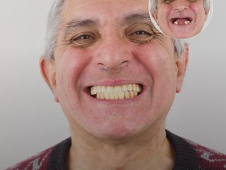 Implantes dentales antes y después - 879125