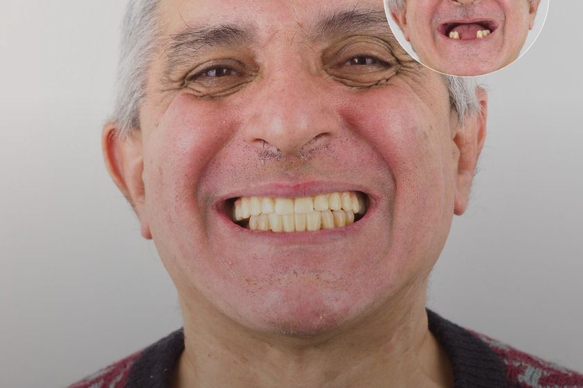Implantes dentales antes y después - 879125