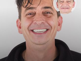 Implantes dentales antes y después - 879126