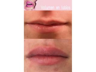 Relleno de labios - Dra. Julieta Settecasi
