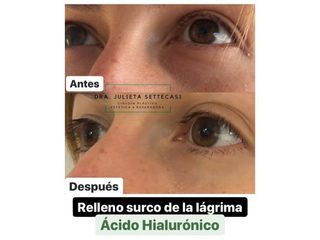 Ácido hialurónico - Dra. Julieta Settecasi