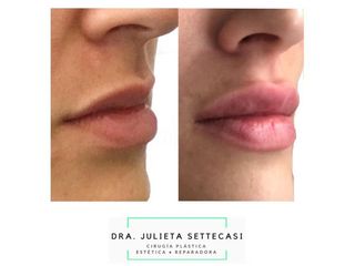 Relleno de labios - Dra. Julieta Settecasi