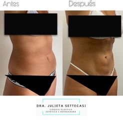 Liposucción ultrasónica - Dra. Julieta Settecasi