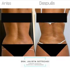 Liposucción ultrasónica - Dra. Julieta Settecasi