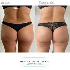 Liposucción ultrasónica + aumento glúteo - Dra. Julieta Settecasi