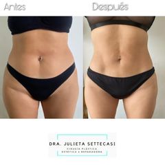Liposucción HD - Dra. Julieta Settecasi