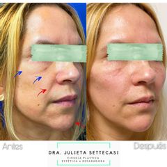 Rellenos faciales - Dra. Julieta Settecasi
