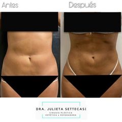 Liposucción ultrasónica - Dra. Julieta Settecasi