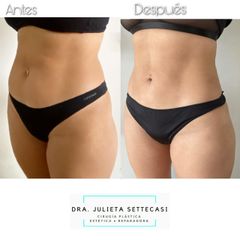 Liposucción ultrasónica - Dra. Julieta Settecasi