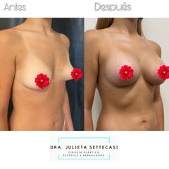Aumento mamas - Dra. Julieta Settecasi