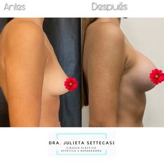 Aumento mamas - Dra. Julieta Settecasi