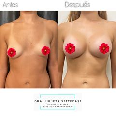 Aumento mamas  - Dra. Julieta Settecasi