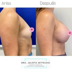 Aumento mamas  - Dra. Julieta Settecasi