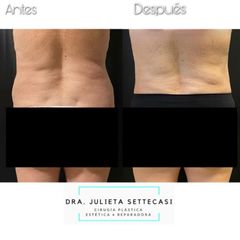 Liposucción - Dra. Julieta Settecasi