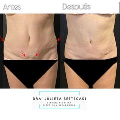 Abdominoplastia - Dra. Julieta Settecasi