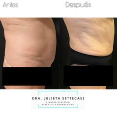Abdominoplastia - Dra. Julieta Settecasi