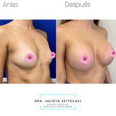 Aumento mamas  - Dra. Julieta Settecasi