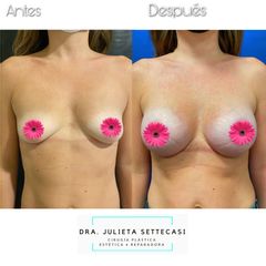 Aumento mamas  - Dra. Julieta Settecasi