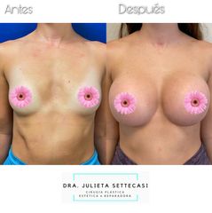 Aumento mamas  - Dra. Julieta Settecasi