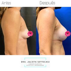 Aumento mamas  - Dra. Julieta Settecasi