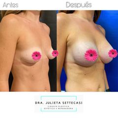 Aumento mamas - Dra. Julieta Settecasi