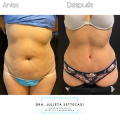 Abdominoplastia - Dra. Julieta Settecasi