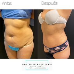 Abdominoplastia - Dra. Julieta Settecasi