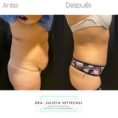 Abdominoplastia - Dra. Julieta Settecasi