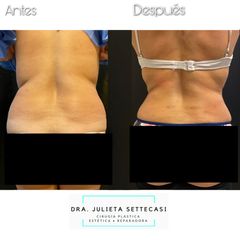 Abdominoplastia - Dra. Julieta Settecasi