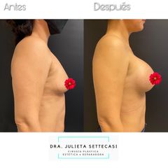 Aumento mamario - Dra. Julieta Settecasi