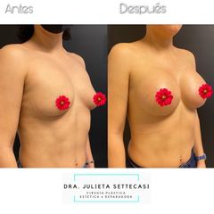 Aumento mamario - Dra. Julieta Settecasi