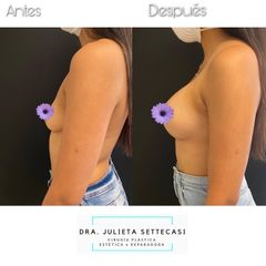 Aumento mamario - Dra. Julieta Settecasi