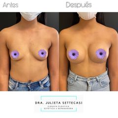 Aumento mamario - Dra. Julieta Settecasi