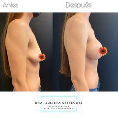 Aumento mamario - Dra. Julieta Settecasi